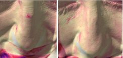 Laser Vascolare