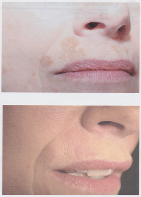 Estetica Laser