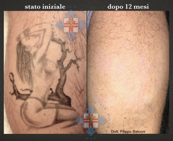 Centro Laser