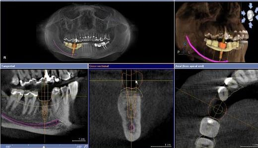 Implantologia