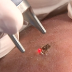 Centro Laser