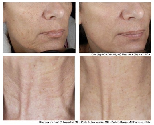 Estetica Laser